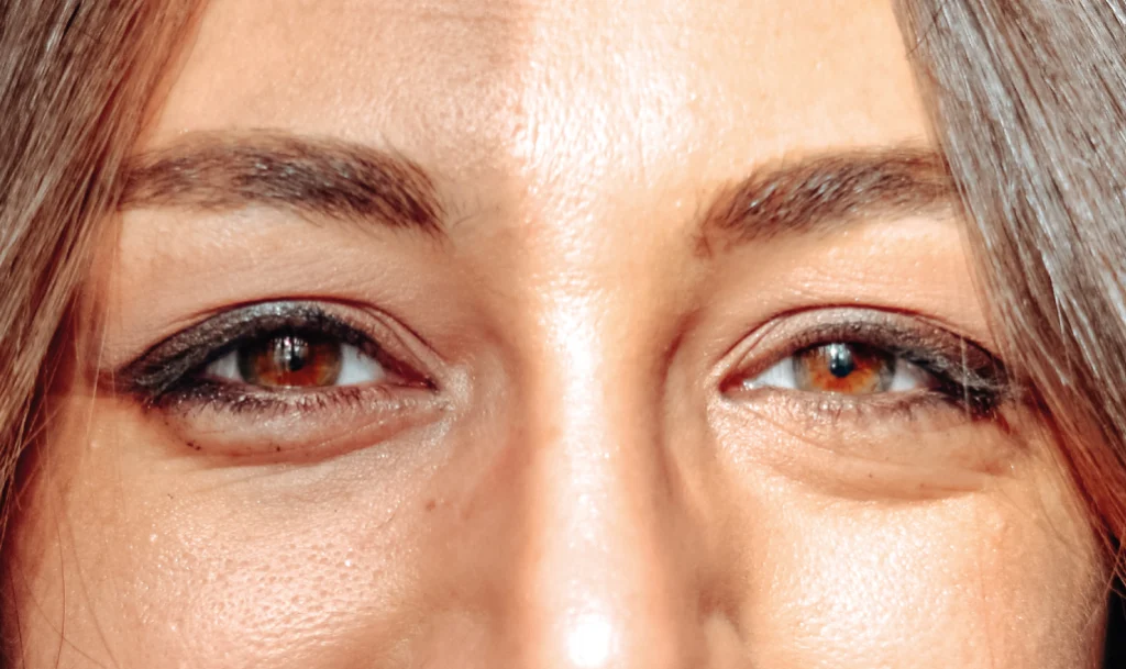 Comparativa entre Blefaroláser y Blefaroplastia Quirúrgica en Clínica Lorents.