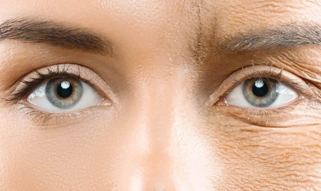rejuvenecimiento-mirada-blefaroplastia-laser.
Alt-text: Resultados naturales de blefaroplastia con láser en Clínica Lorents, eliminando bolsas en los ojos.
