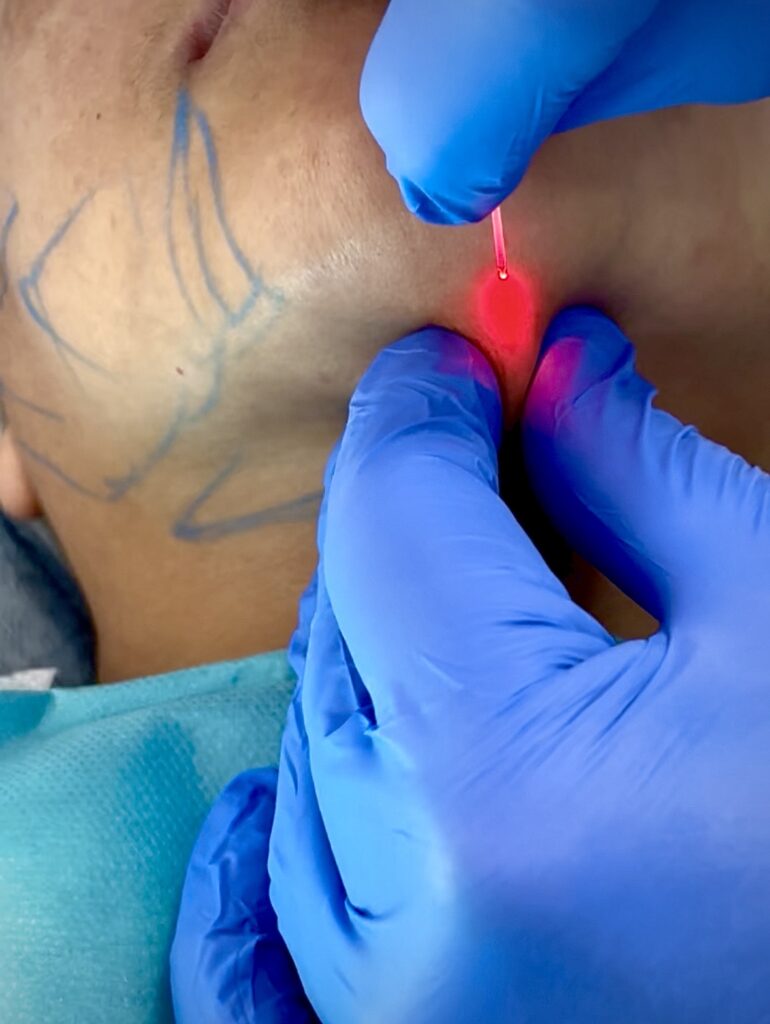 Aplicación de láser endolifting mediante fibra óptica para eliminar grasa de la papada en Murcia