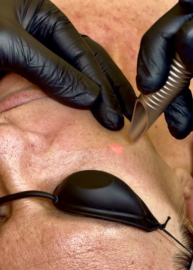 Aplicación de peeling láser facial en Clínica Lorents Murcia para rejuvenecimiento de la piel
