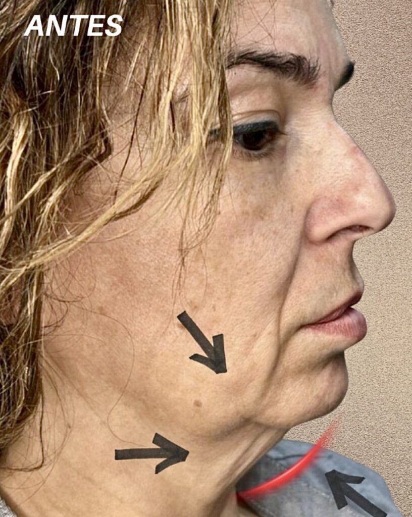Perfil de paciente antes del endolifting mostrando flacidez en cuello y pérdida de definición mandibular