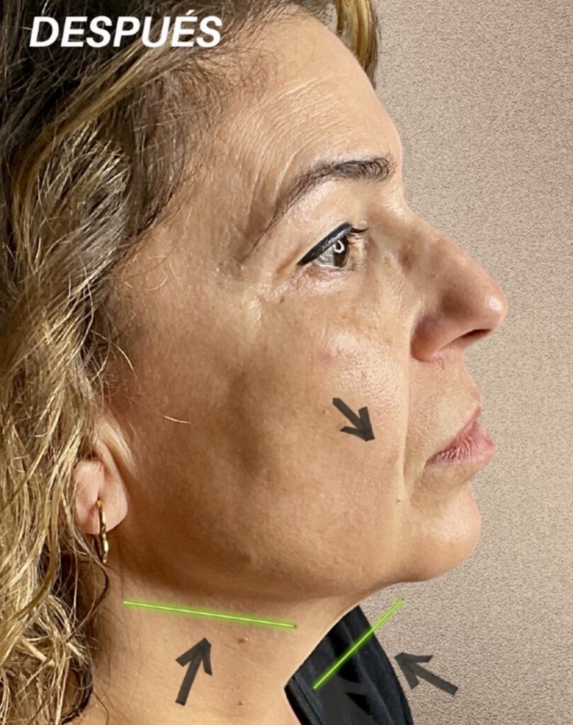 Resultado tras endolifting en Murcia con perfil mandibular definido y cuello terso