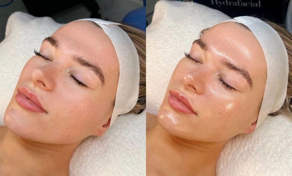 Comparación antes y después del tratamiento Hydrafacial mostrando piel limpia y con efecto glow inmediato