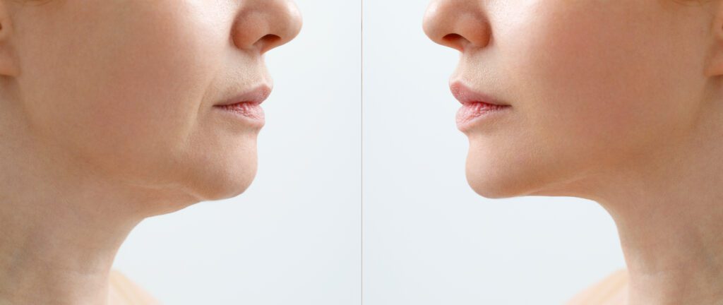Visualización gráfica de mapa de zonas faciales para tratamiento de Endolifting facial en Murcia sin cirugía, ideal para reafirmar el rostro en verano, Clínica Lorents