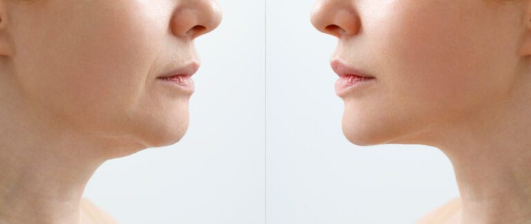 Visualización gráfica de mapa de zonas faciales para tratamiento de Endolifting facial en Murcia sin cirugía, ideal para reafirmar el rostro en verano, Clínica Lorents