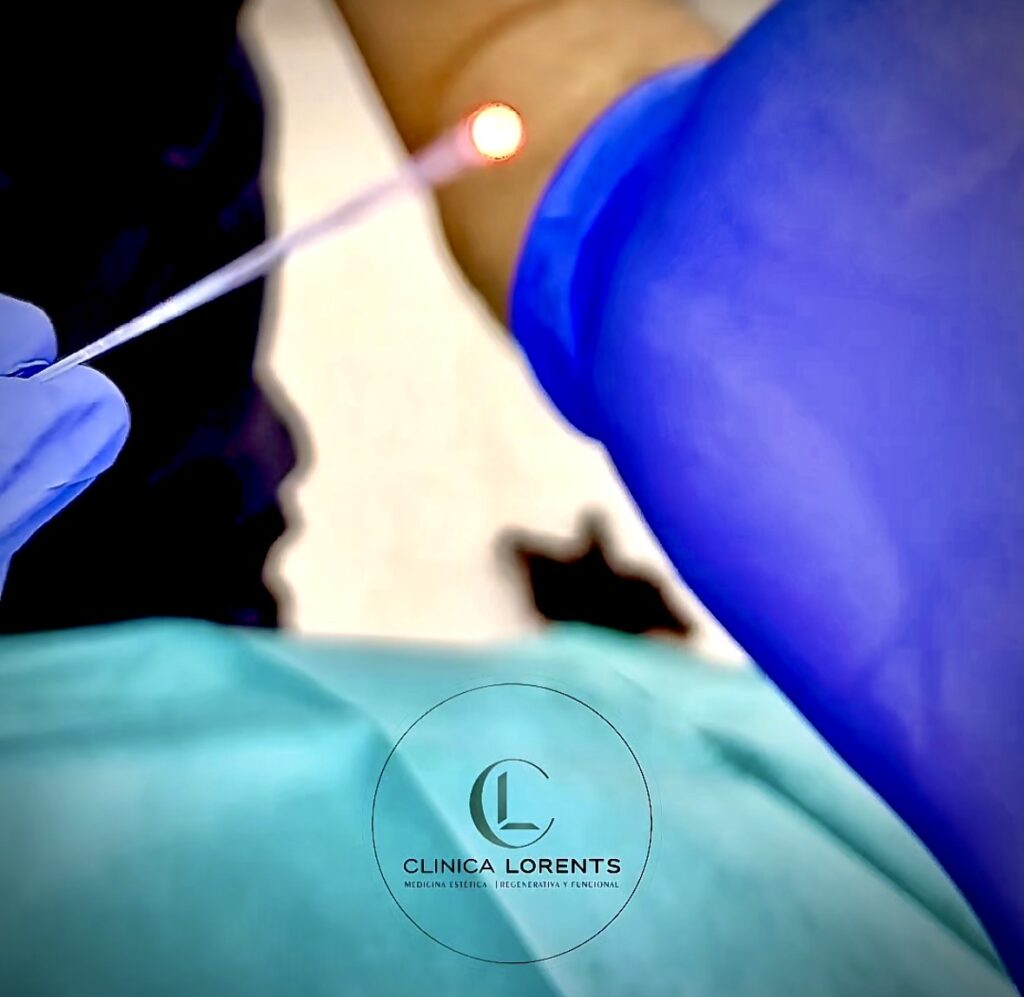 Primer plano de una fina microfibra óptica láser sostenida por un guante médico azul, utilizada para el tratamiento de endolifting corporal en Clínica Lorents Murcia para eliminar grasa localizada y reafirmar la piel semanas antes de tu evento.