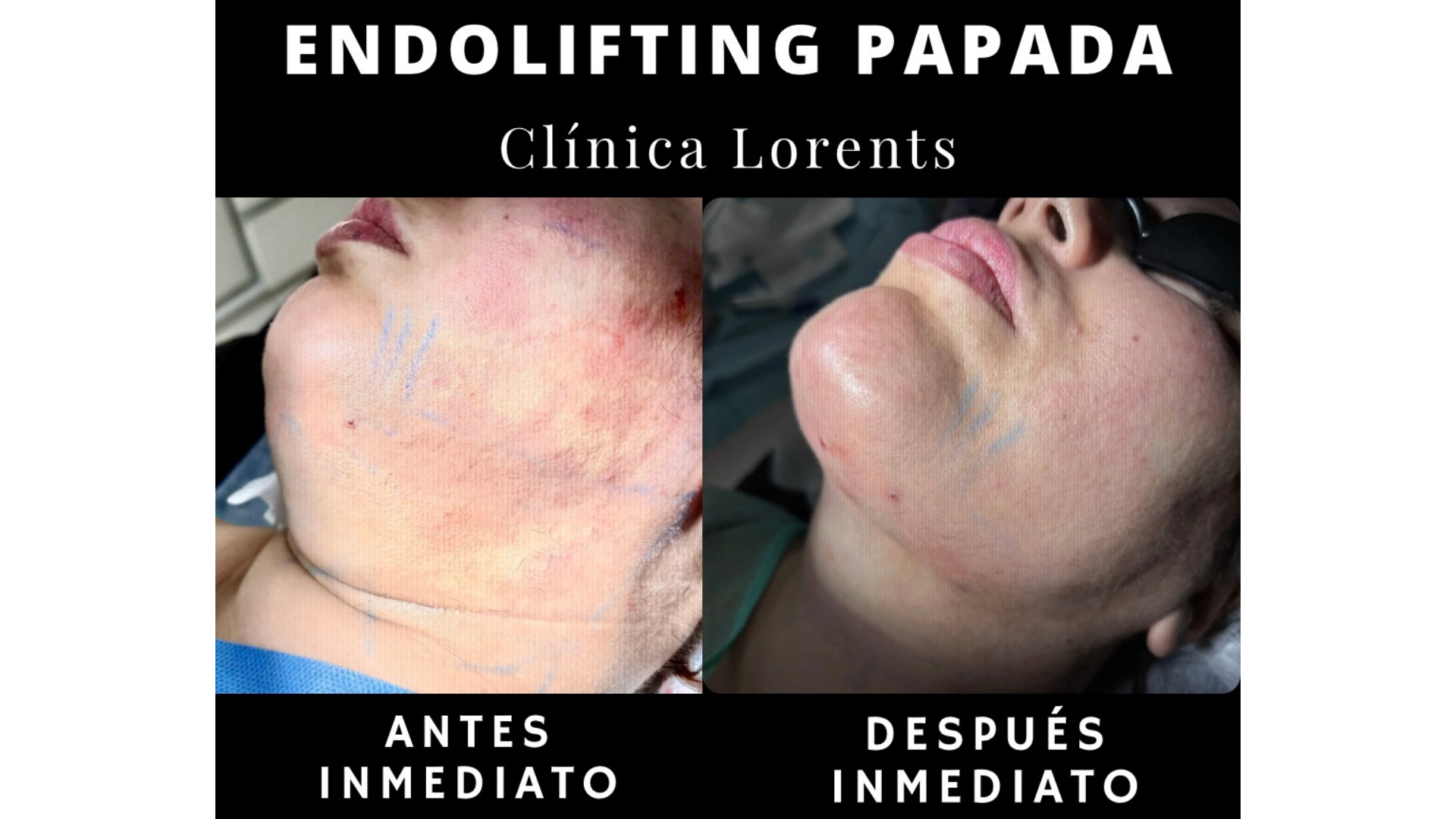 Comparación clínica de antes y después (Post Inmediato) de un tratamiento de endolifting de papada en perfil, mostrando la reducción de grasa submental y la definición inmediata de la línea mandibular.