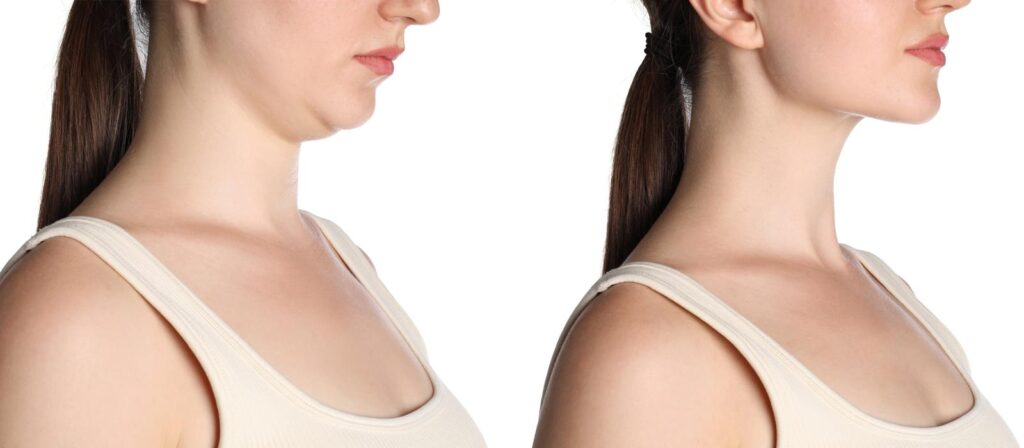 Comparativa de antes y después de eliminar la papada sin cirugía en Murcia, mostrando un perfil facial definido tras el tratamiento de endolifting en Clínica Lorents.