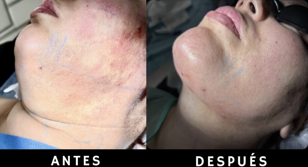 Comparación vertical de antes y después inmediato de endolifting de papada en perfil, resaltando la rápida marcación y definición de la línea mandibular tras el tratamiento en Murcia.