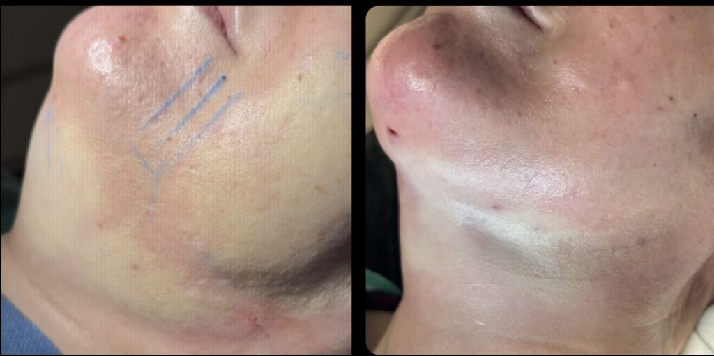 Comparación vertical de antes y después inmediato de endolifting de papada, enfatizando la instantánea reducción del volumen de grasa y la flacidez del cuello en Murcia.