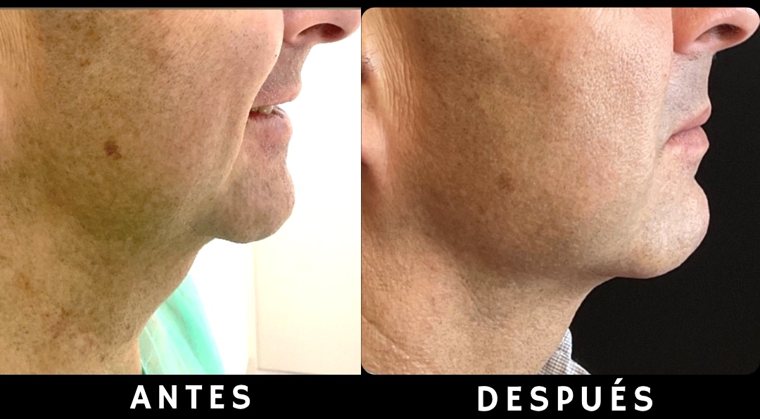 Resultado de perfil de endolifting de papada enfocado en la eliminación de grasa submental y la retracción de los tejidos del cuello.