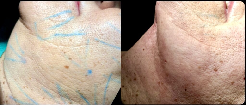 Comparativa directa de antes y después de endolifting de papada en una galería clínica, ilustrando resultados dramáticos en la definición del cuello y el óvalo facial en Murcia.