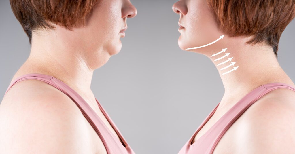 Imagen de portada mostrando a una mujer con perfil definido y cuello terso tras tratamiento de endolifting-lipoláser de papada en Murcia.