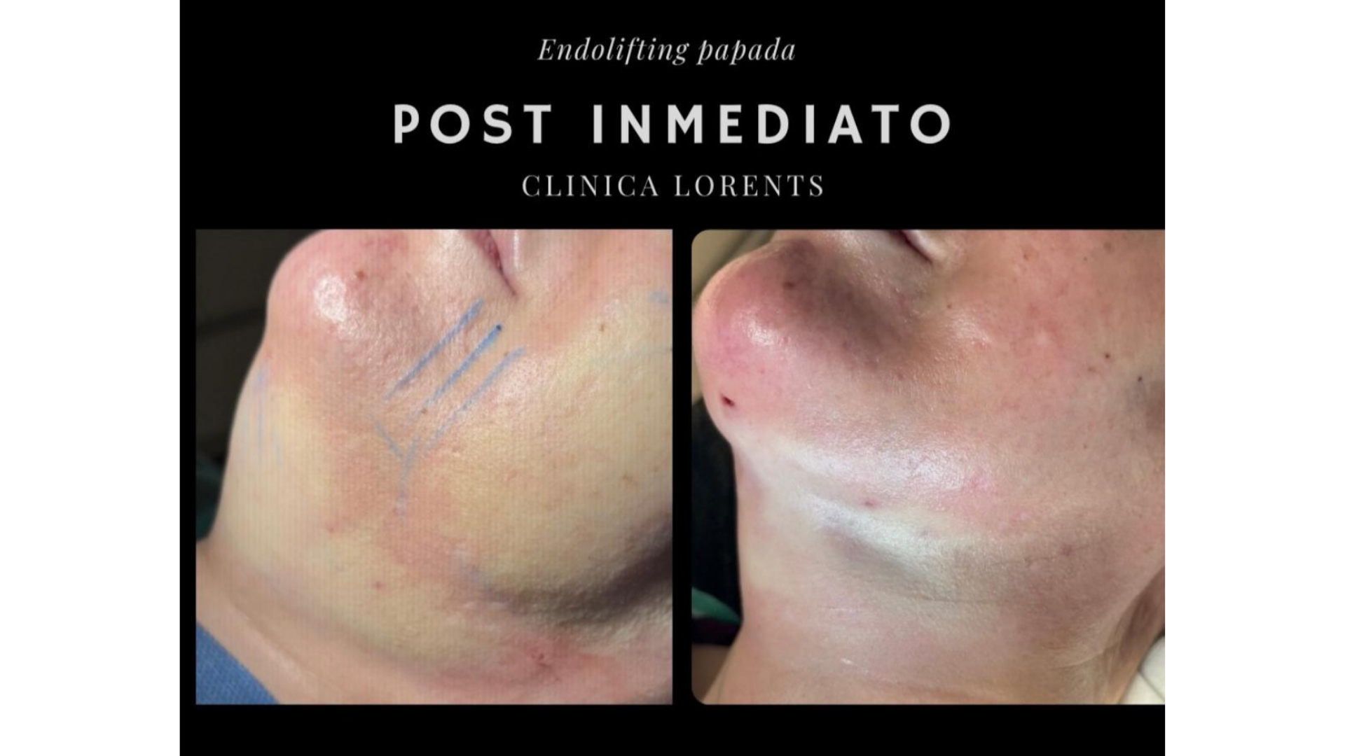 endolifting-papada-post-inmediato-clinica-lorents-murcia.jpg
