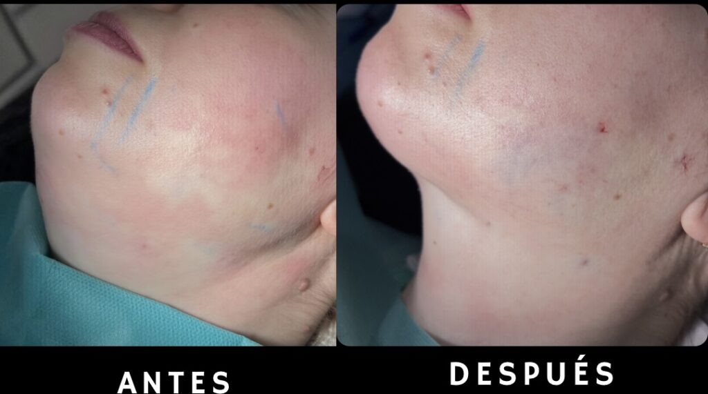 Galería de casos de antes y después de endolifting de papada, mostrando la eficacia en la reducción de grasa y flacidez en diferentes perfiles de pacientes en Murcia.