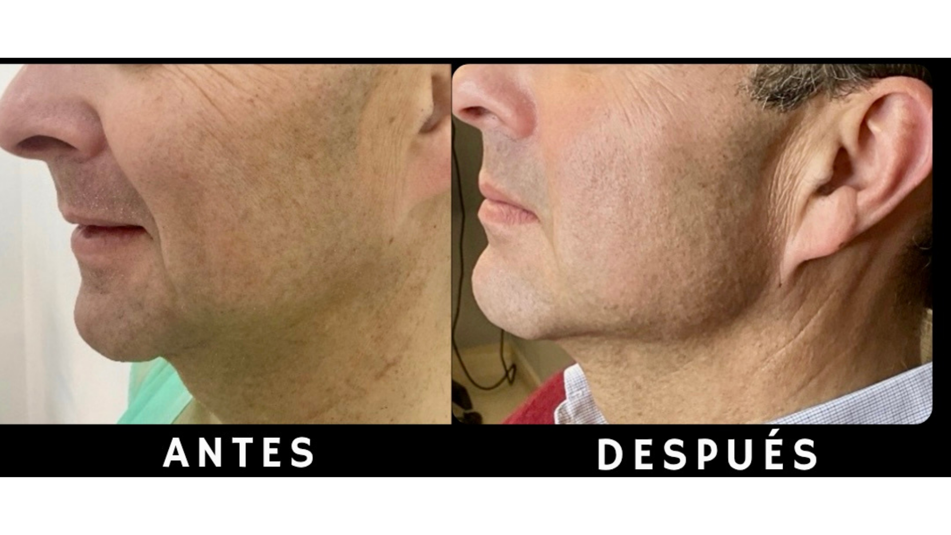 Perfil comparativo de endolifting de papada centrado en la marcación y definición de la línea mandibular tras el tratamiento en Clínica Lorents.