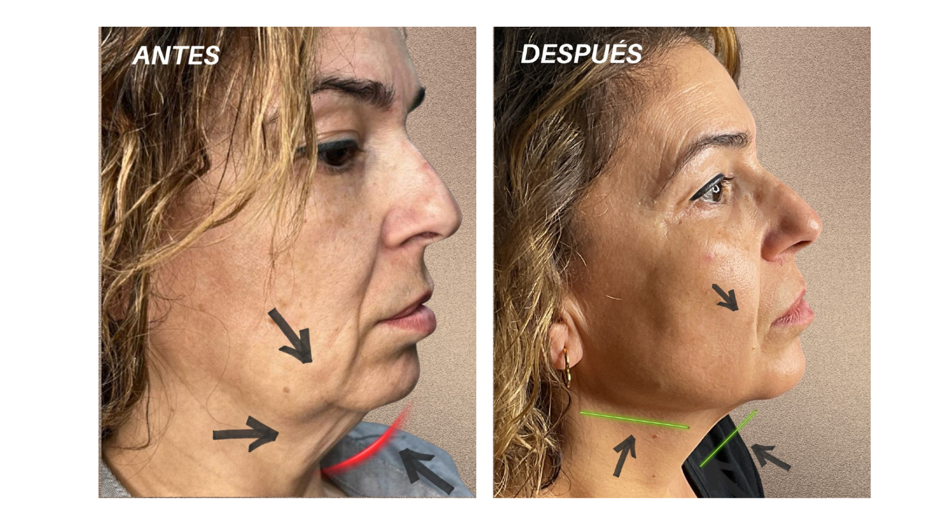 Perfil de mujer mostrando un arco mandibular definido y un cuello firme y sin papada, indicativo de los resultados del tratamiento para eliminar la papada sin cirugía en Clínica Lorents Murcia.