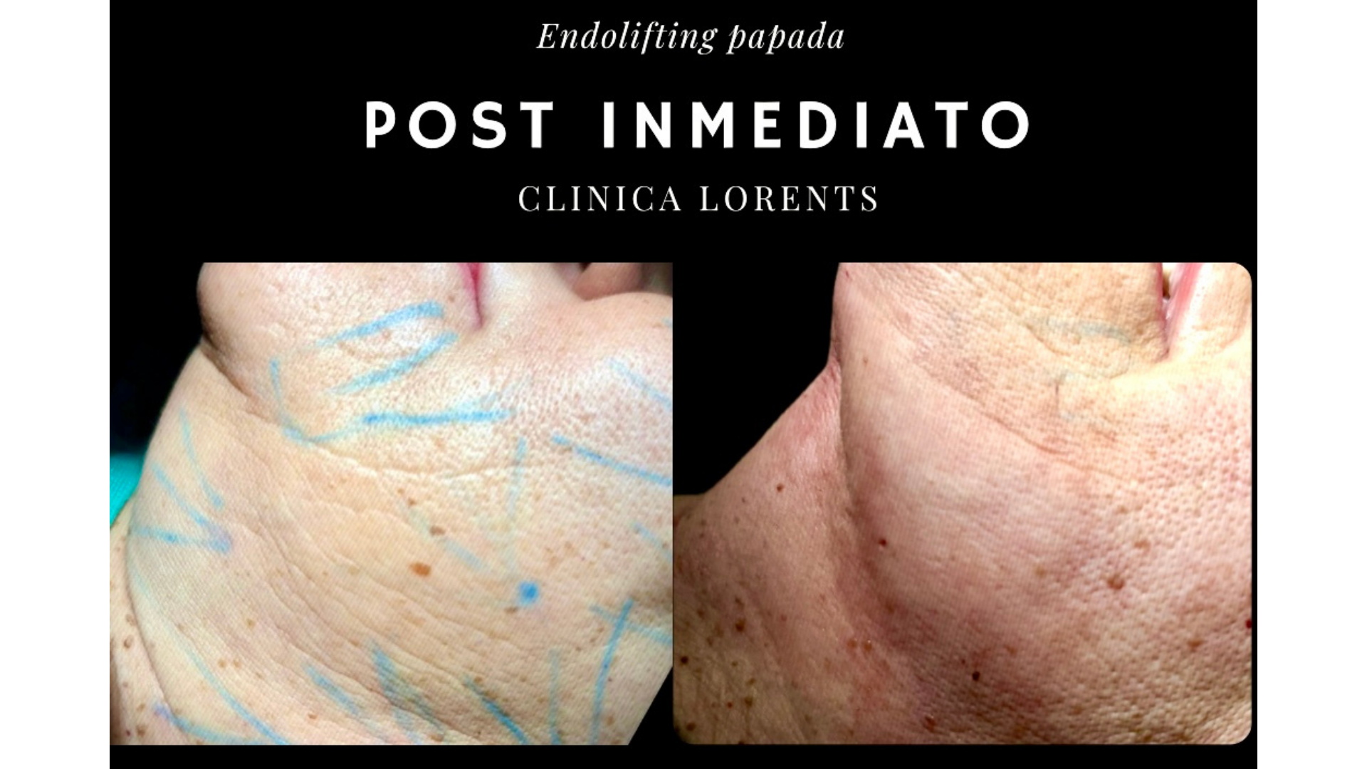 Resultado post inmediato de endolifting de papada en Clínica Lorents Murcia, comparativa de antes con marcaje médico y después con tensado de piel visible.