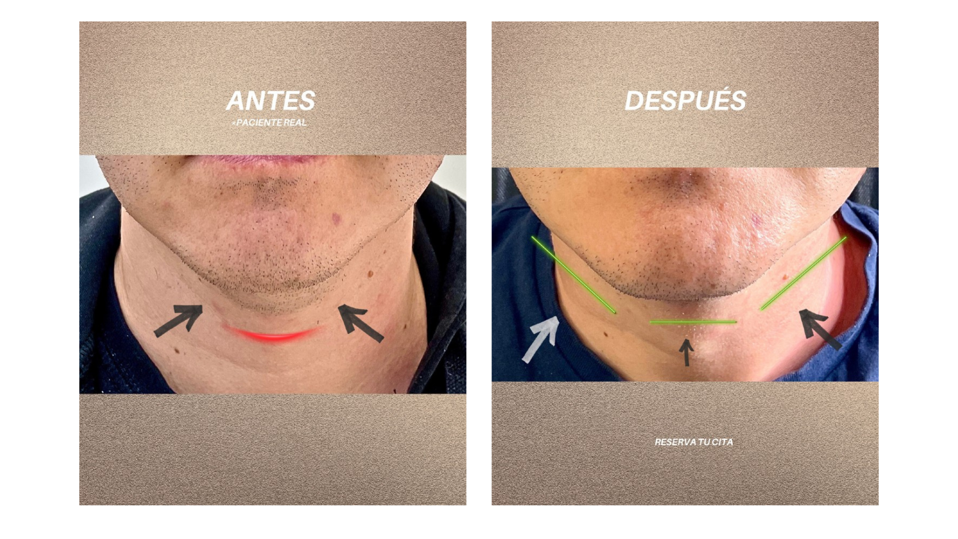 Comparativa de antes y después de un tratamiento de endolifting de papada en Murcia, mostrando la eliminación de flacidez y redefinición del cuello en Clínica Lorents.