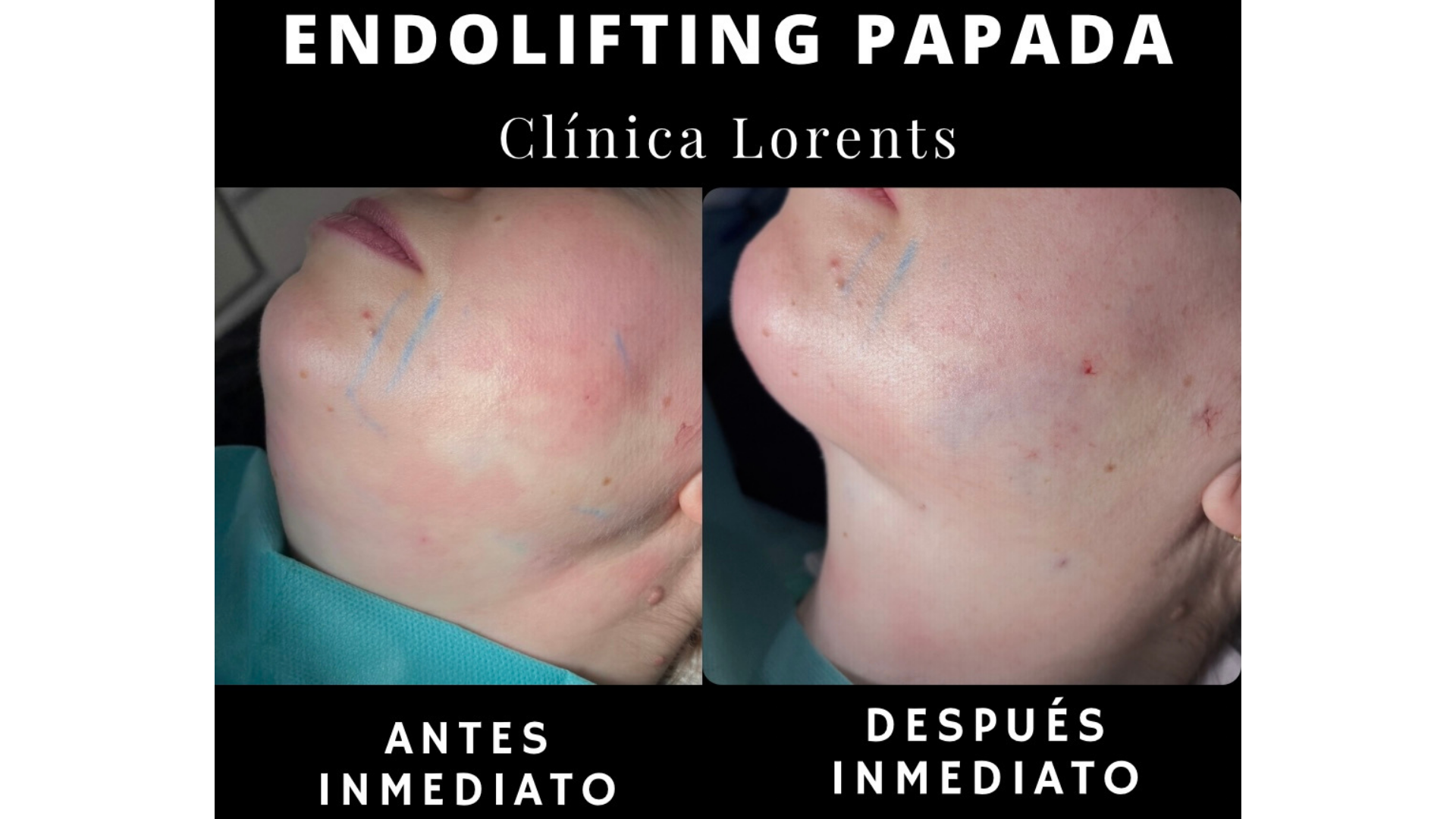 Comparativa de resultados antes y después inmediato de endolifting de papada en Clínica Lorents Murcia, mostrando el perfil mandibular redefinido.