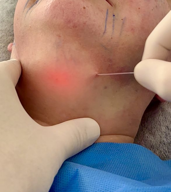 Primer plano del procedimiento de endolifting de papada con fibra óptica láser en Clínica Lorents Murcia, mostrando la tecnología láser bajo la piel para eliminar grasa y flacidez.