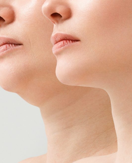 Comparativa de perfiles faciales para identificar candidatos al tratamiento de papada en Murcia, mostrando flacidez submental frente a un contorno mandibular definido.